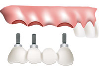 Solutions for Missing Teeth & Denture Wearers