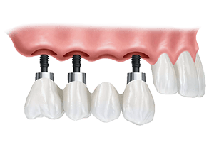 Solutions for Missing Teeth & Denture Wearers